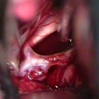 Aneurysma