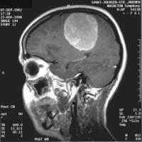 Hirntumor